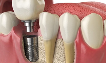 a 3 D illustration of a dental implant in the jawbone