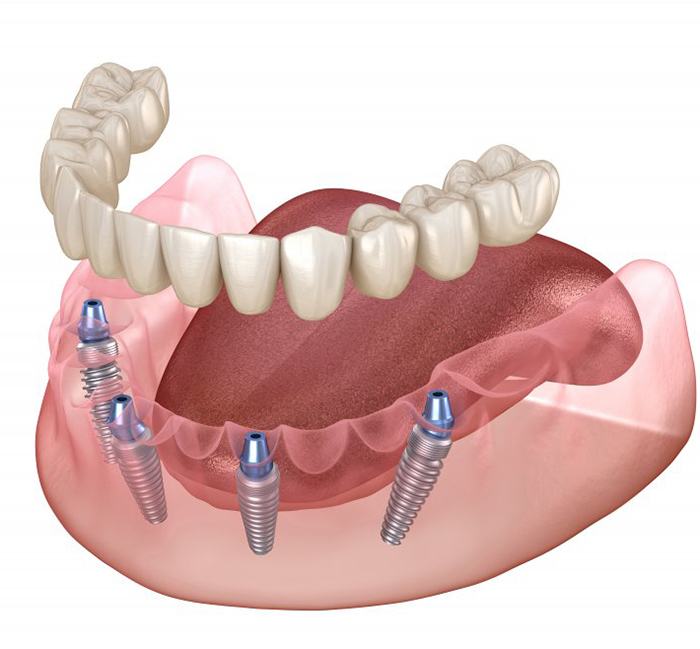 Illustration of All-on-4 dental implants with denture