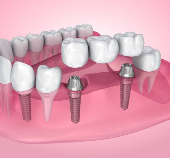 Illustration of traditional implants with bridge