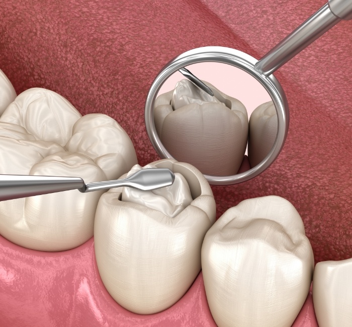 Animated smile during tooth colored filling placement