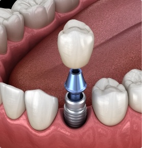 Animated smile during dental implant supported dental crown placement