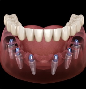 Animated smile during dental implant supported denture placement