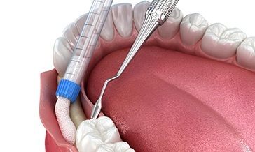 3D render of a bone graft