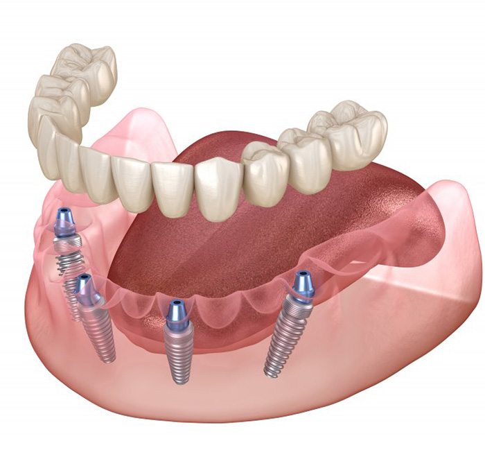 Illustration of implant dentures