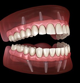 Illustration of fixed implant dentures