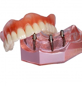 Model of removable implant dentures