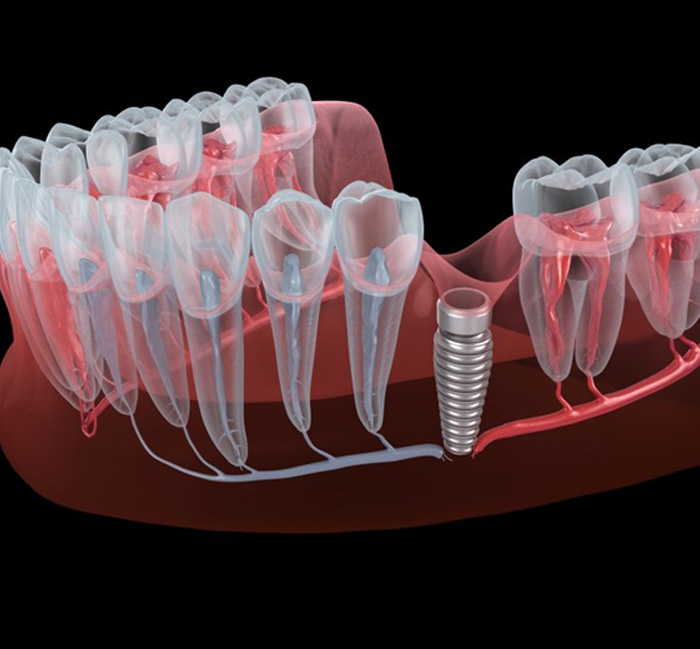 Illustration of dental implant in gum tissue