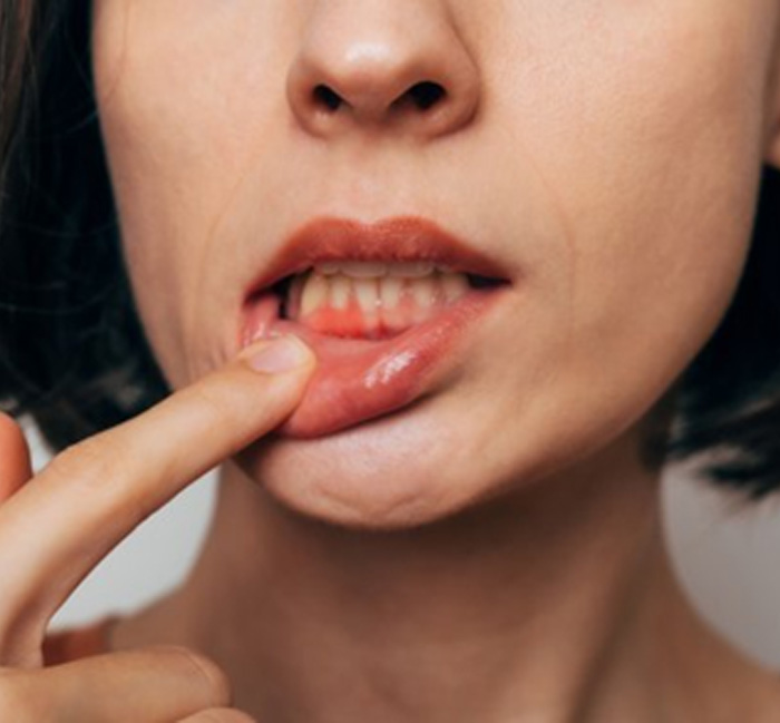 Lady has inflamed gum tissue