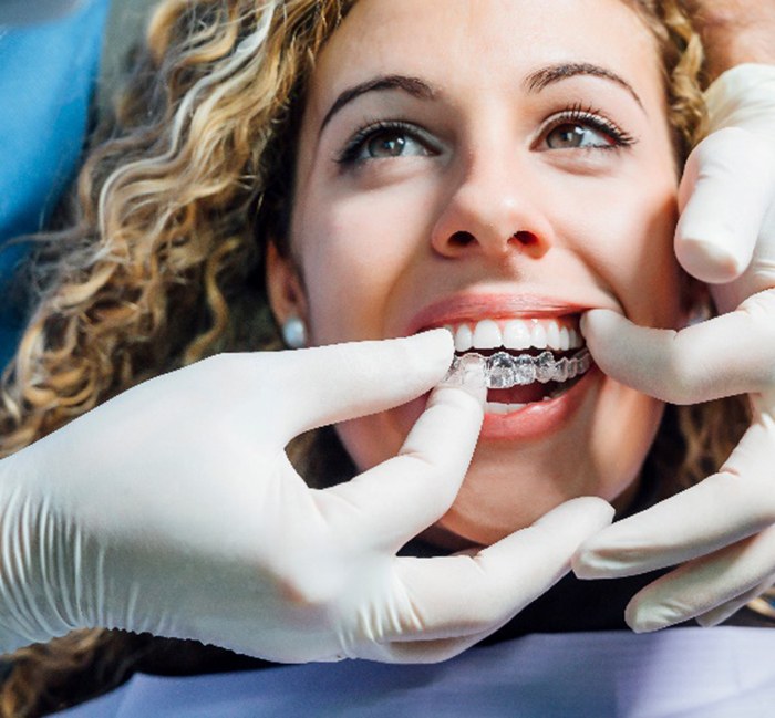 Dentist placing Invisalign aligner on patient's top teeth