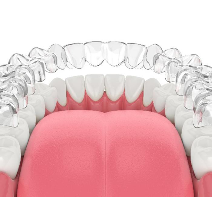 Illustration of clear aligner being placed on bottom teeth