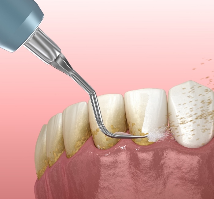 Gum Disease Treatment Oak Point, TX Periodontal Therapy Oral Health