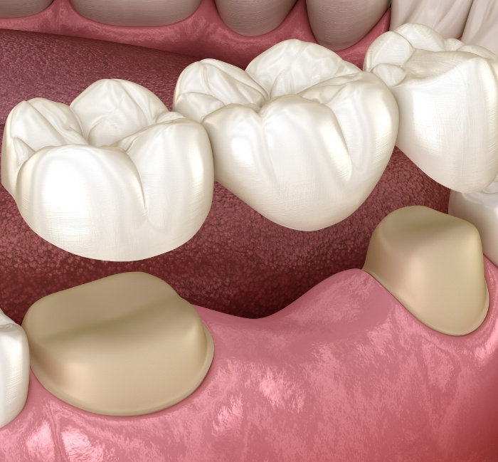 Animated smile during dental implant tooth replacement