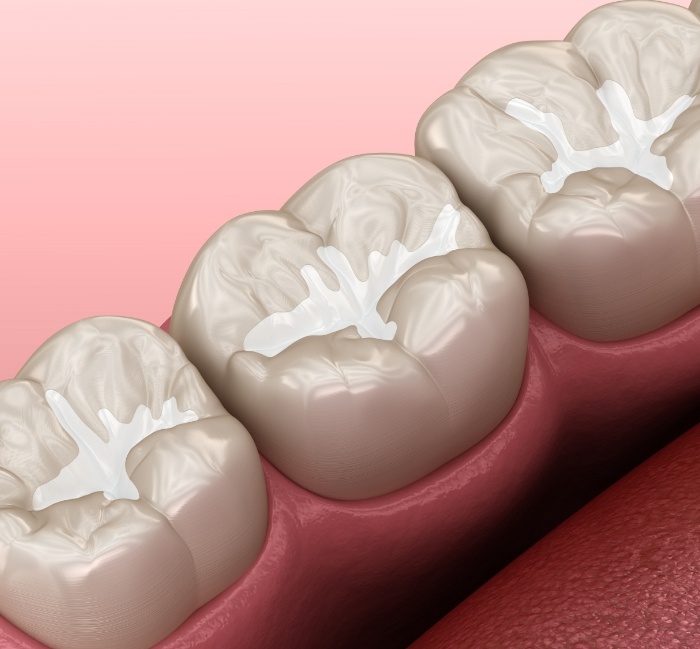 Animated smile with tooth colored fillings