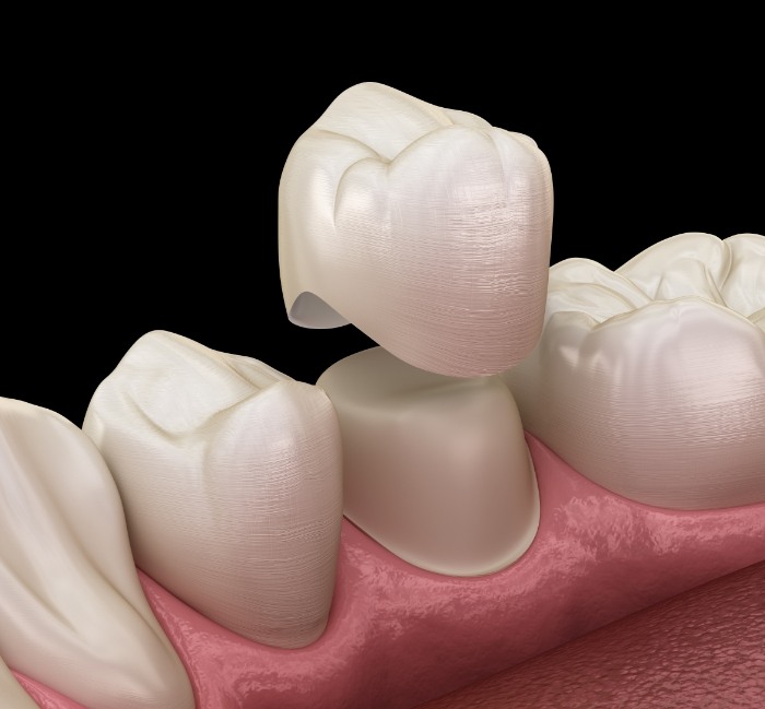 Animated smile during dental crown placement