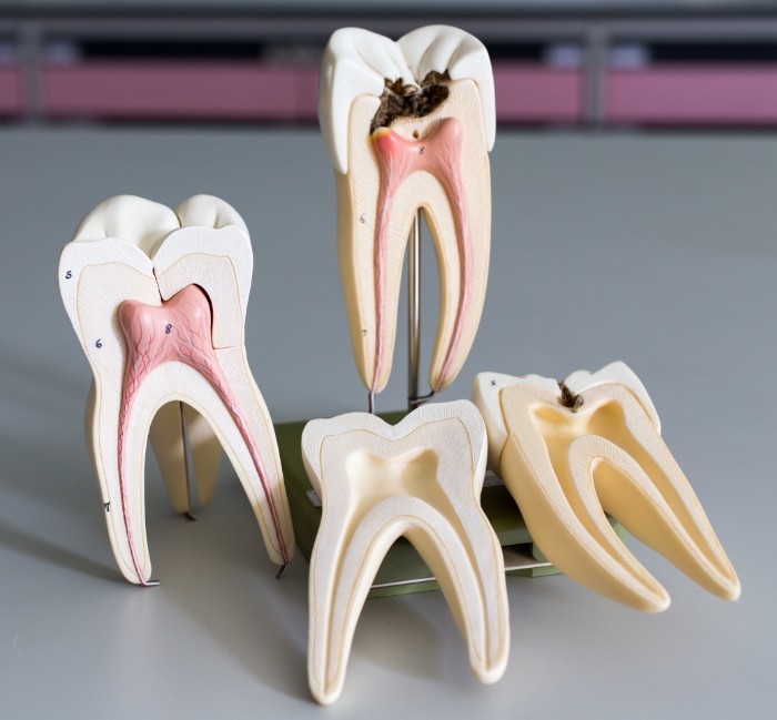 Model of healthy tooth compared to model tooth in need of root canal treatment