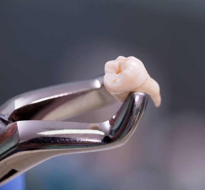 Clasp holding tooth after extraction