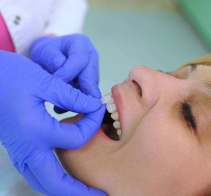 A dentist placing a patient’s veneers