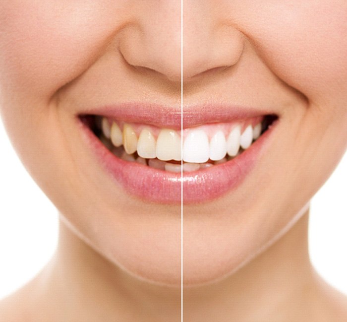 woman smiling before and after teeth whitening