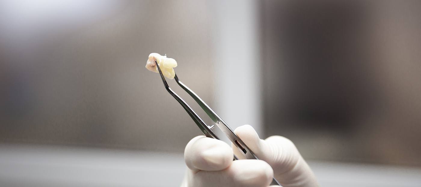 Dentist holding a wisdom tooth