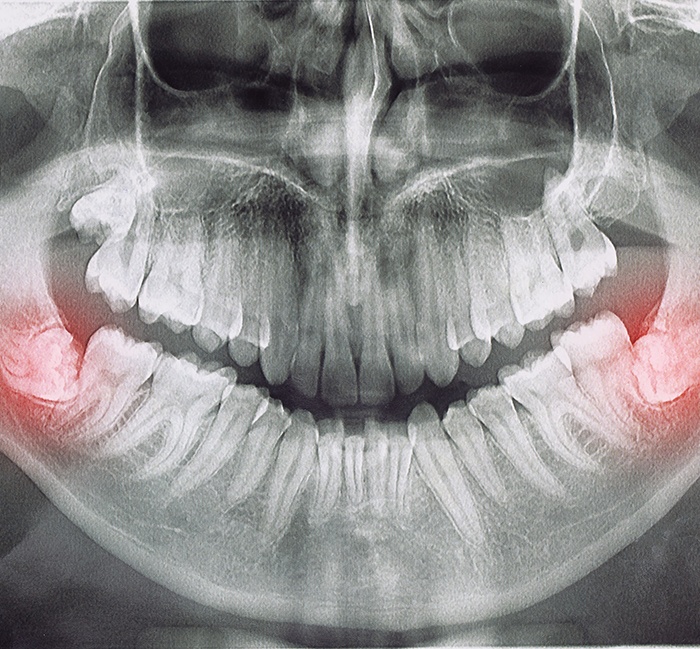 X-ray of impacted wisdom teeth